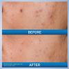 imageCeraVe Acne Control Gel 2 Salicylic Acid Treatment With Glycolic Acid  Lactic Acids  Niacniamide Acne Gel Helps Clear Blemishes Without Over Drying Alcohol Free ampamp Oil Free 135 Fl Oz