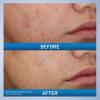 imageCeraVe Acne Foaming Cream Wash Gentle Face and Body Cleanser with Benzoyl Peroxide 10 Hyaluronic Acid and Niacinamide 10 Benzoyl Peroxide Treatment Clears Pimples and Blackheads 5 Oz