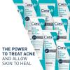 imageCeraVe Acne Foaming Cream Cleanser 4 Benzoyl Peroxide Face Wash With Hyaluronic Acid Niacinamide ampamp Ceramides Gentle Daily Acne Treatment For Face
